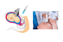 Amniocentesis Genética (Cariotipo Fetal)